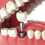 calgary-dental-implants-calgary