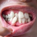 calgary-invisalign-dentist